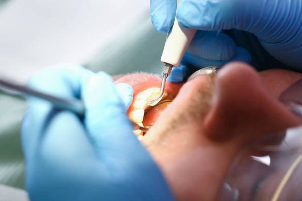 Best Emergency Wisdom Teeth Removal in Brookdale, SC